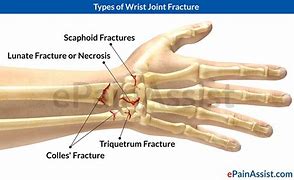 Image result for Outer Wrist Pain