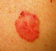 Image result for Red Dot Skin Cancer