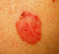 Image result for Red Flat Skin Lesion