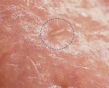 Image result for Mites Under Skin