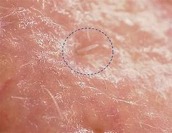 Image result for Human Skin Mites