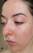 Image result for Banish Acne Scars