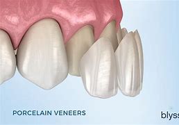 Image result for Outdoor Veneers