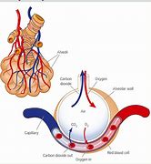 Image result for Acute Pulmonary Oedema and Fluid Overload