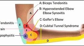 Image result for Outer Elbow Pain