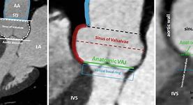 Image result for Anatomical Site of Left Ventricular Outflow Tract