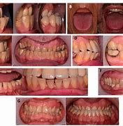 Image result for Acromegaly Teeth