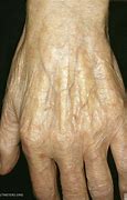 Image result for Skin Atrophy Diagram