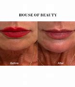 Image result for Chin Correction Filler