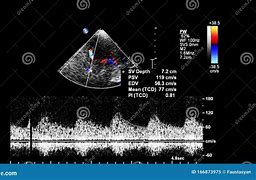 Image result for Continuous Wave Doppler Ultrasound