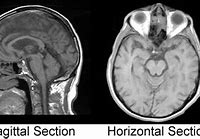 Image result for Coronal Plane Brain MRI