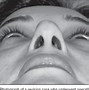 Image result for Nasal Alar Groove