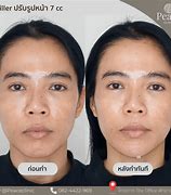 Image result for Chin Correction Filler