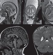 Image result for Cerebellar Vermis MRI