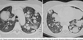 Image result for Multiple Lung Nodules