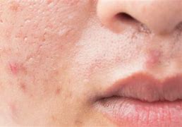 Image result for Pimple Face Wallpaper