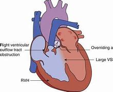 Image result for Right Ventricular Outflow Tract