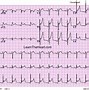 Image result for Pericarditis EKG Findings Example