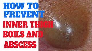 Image result for Ingrown Hair Causing Boils