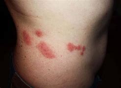 Image result for Big Bed Bug Bites