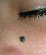 Image result for Face Mole Eye