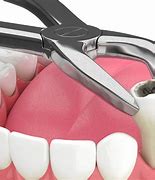 Image result for Alendronate and Dental Extractions