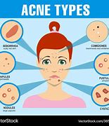 Image result for Pimples and Blackheads On Face