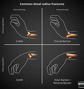 Image result for Volar vs Dorsal