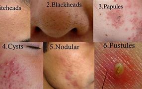 Image result for Hives with Pustules