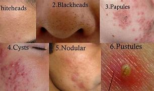 Image result for Hives with Pustules