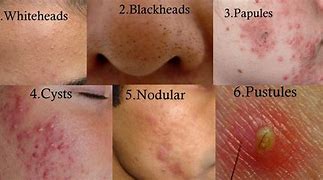 Image result for Pustules and Papules On Face