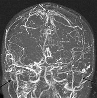 Image result for Thrombose Veineuse Musculaire IRM