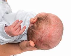 Image result for Eczema On Baby Arm