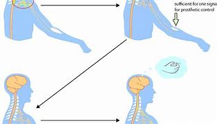 Image result for Brachial Plexus Fall Injury