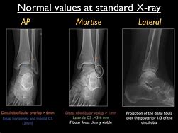 Image result for Ankle Mortise Fracture