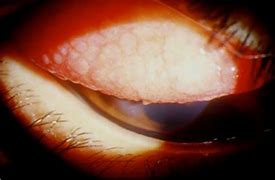 Image result for Tarsal Conjunctiva Papillae