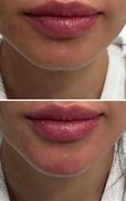 Image result for 1 Ml Chin Filler