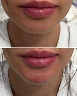 Image result for Chin Correction Filler