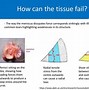 Image result for Meniscus Stress