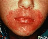 Image result for Candida Face