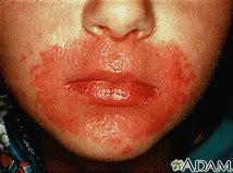 Image result for Candida Rash