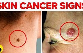 Image result for 5 Warning Signs of Skin Cancer