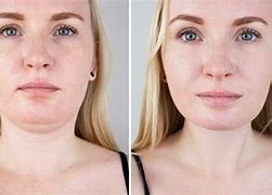 Image result for CoolSculpting Chin Before and After