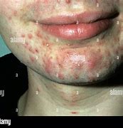 Image result for Pustules and Inflammatory Acne