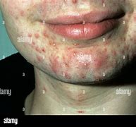 Image result for Pustules and Inflammatory Acne