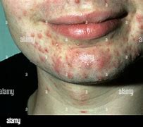 Image result for What Are Pustules On the Skin