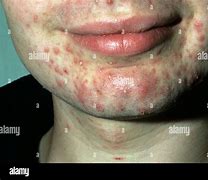 Image result for Pustules Skin Disease