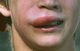 Image result for Bug Bite On Lip