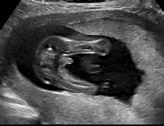 Image result for Male Baby Ultrasound