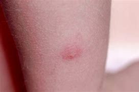 Image result for Bee Mites